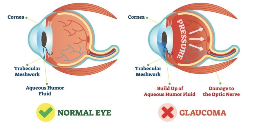 Glaucoma