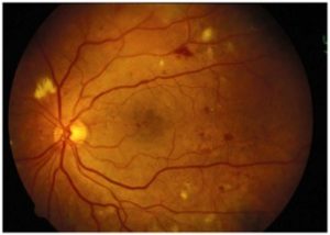 d-retinopathy