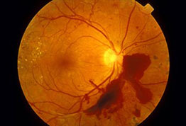 Diabetic Retinopathy: Hemorrhages from the blood vessels.
